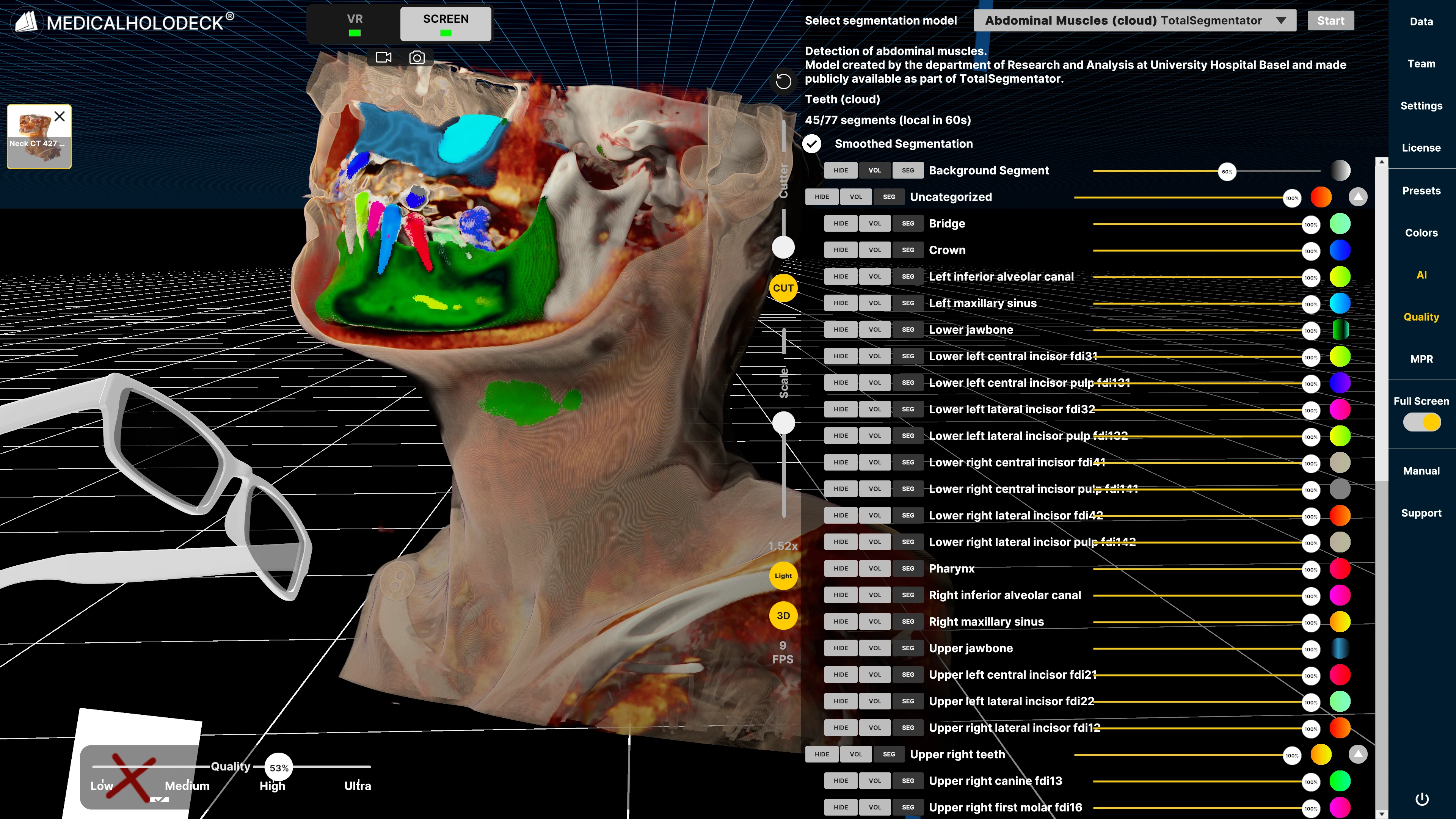 Espaço de trabalho de segmentação Medicalholodeck mostrando estruturas abdominais e controles de modelo.