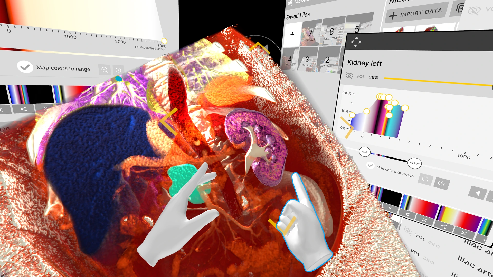 Segmented abdominal anatomy and kidney in Medicalholodeck VR with virtual hands and interface controls