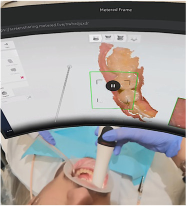 Fast intraoral scanning