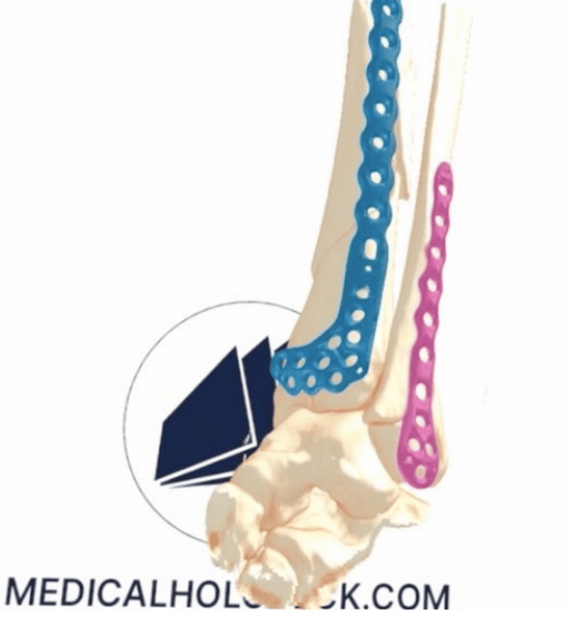 Presurgical planning