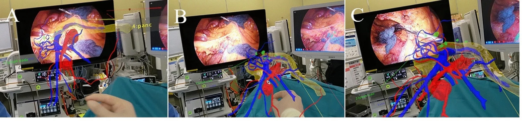 D3 lymph node dissection
