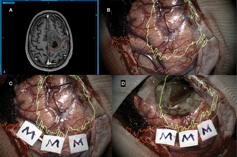 Tumors adjacent eloquent areas