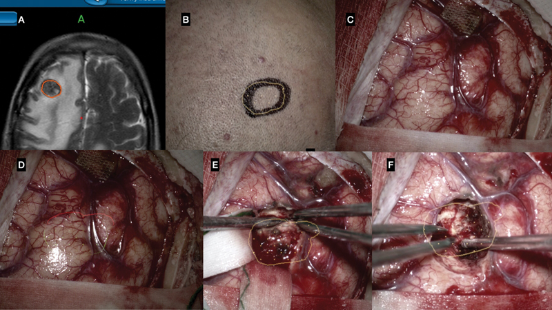 Subcortical tumor resection using AR guidance