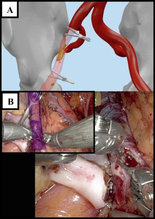 Kidney transplantation