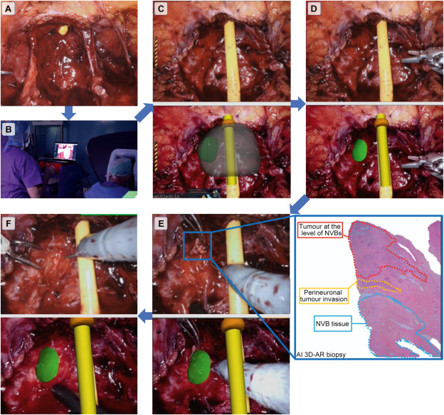 Nerve-sparing with AR