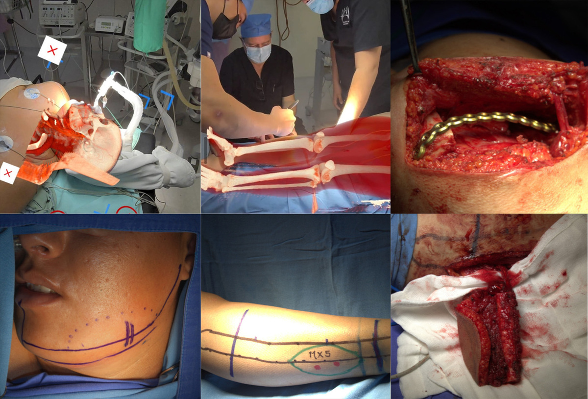 Intraoperative holographic navigation with augmented reality in mandibular reconstruction