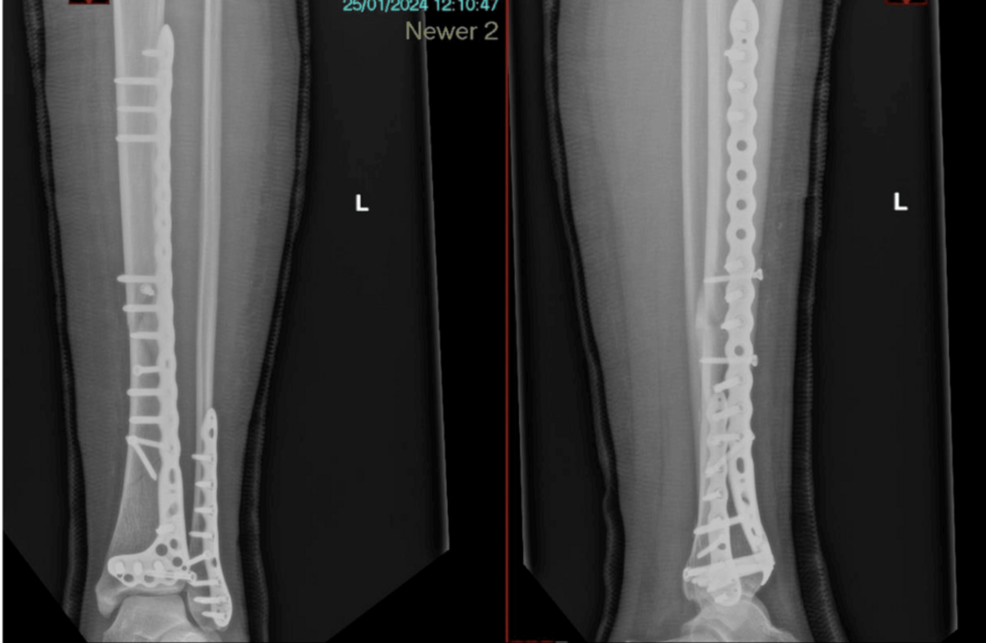 Enhancing preoperative orthopedic planning