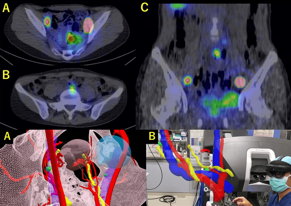 Biopsy in endometrial cancer using AR and MR