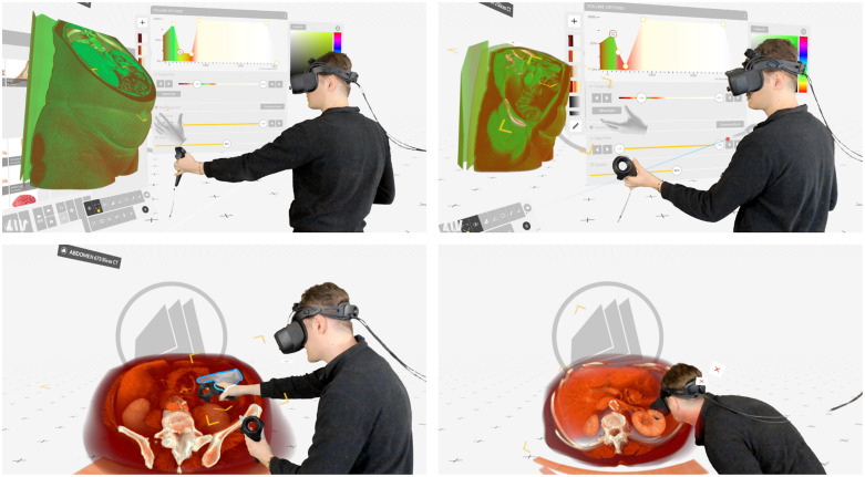 Four views of a researcher using a VR headset and controllers to explore an abdominal CT in Medical Holodeck.