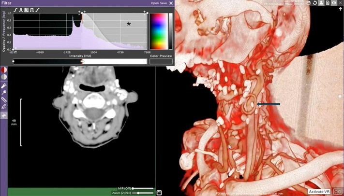 VR in head and neck oncology