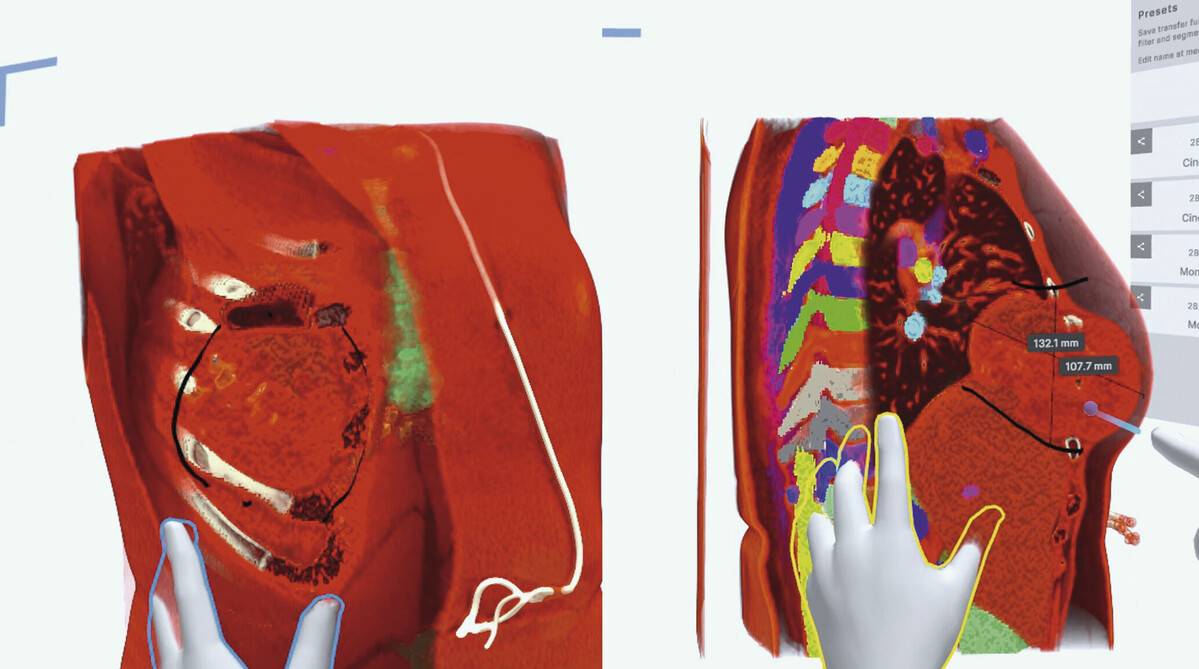 Virtual Reality planning for chest wall resection