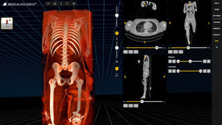History of spatial computing in spine surgery