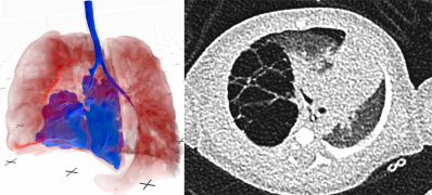 Niedrigdosis-CT, große Wirkung: VR definiert die Kinderchirurgie neu